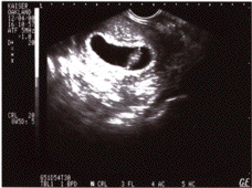 ultrasound1.gif